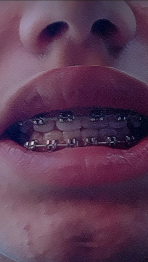 Header of bracesfetish